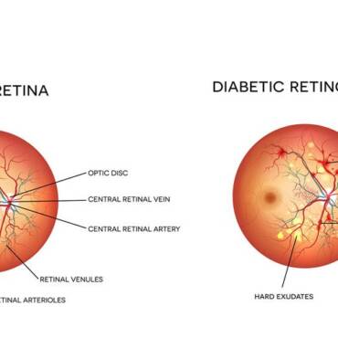 How can an eye exam detect diabetes?