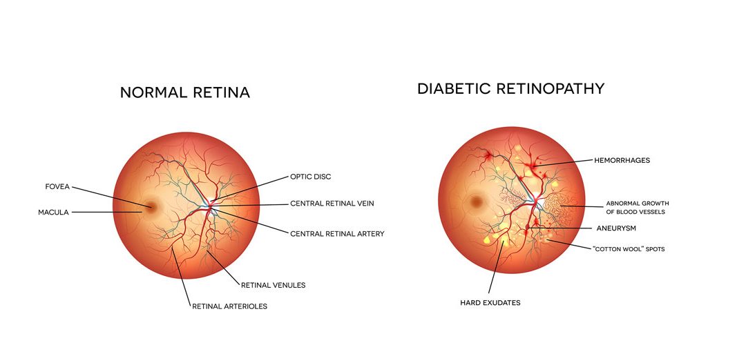How can an eye exam detect diabetes?